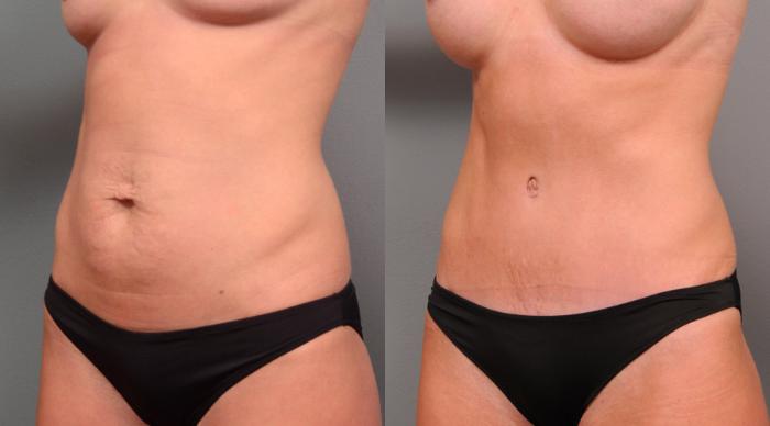 Before & After Tummy Tuck Case 156 View #3 View in New York, NY