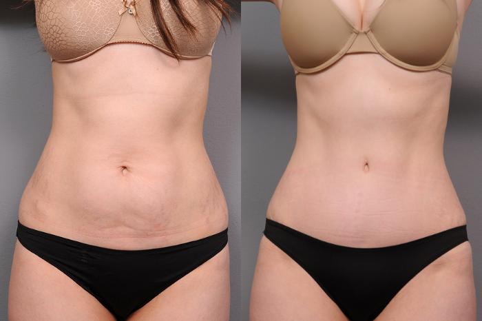 Before & After Tummy Tuck Case 161 View #2 View in New York, NY