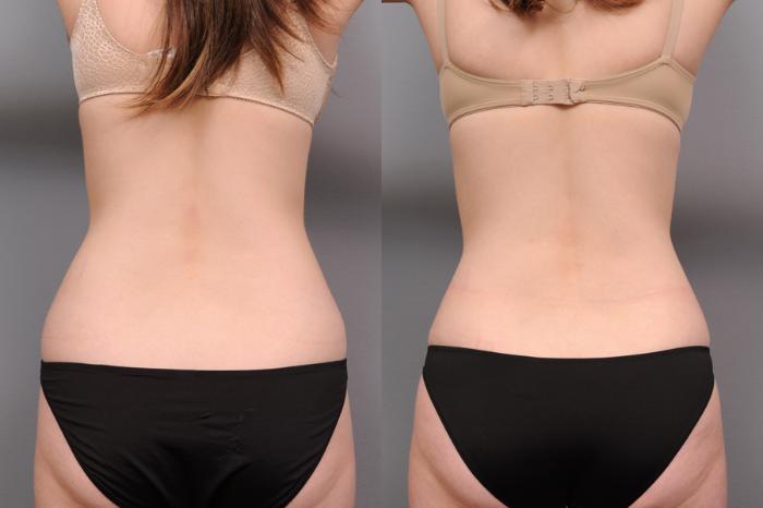 Before & After Tummy Tuck Case 161 View #4 View in New York, NY