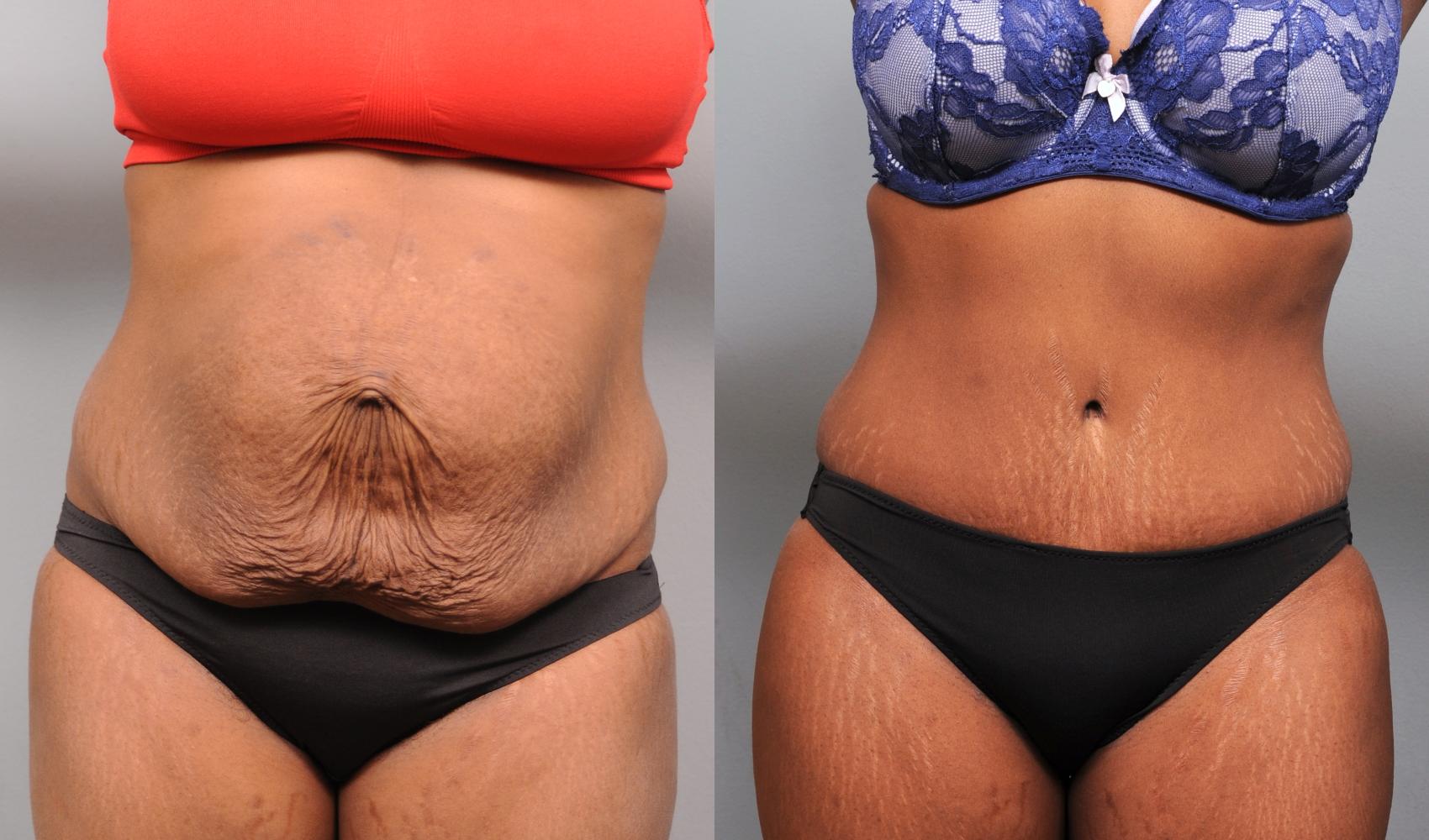 Tummy Tuck with Diastasis Recti Repair New York City
