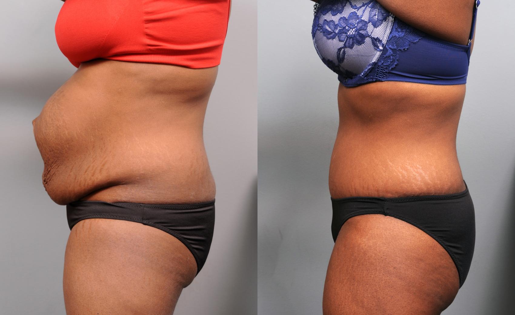 Repair of Diastasis Recti with a Tummy Tuck greatly improves profile
