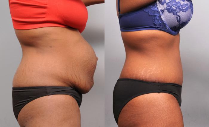 Repair of separated muscles done with Tummy Tuck operation in New York City
