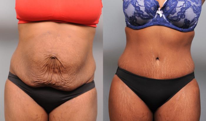 Before & After Tummy Tuck Case 173 View #1 View in New York, NY