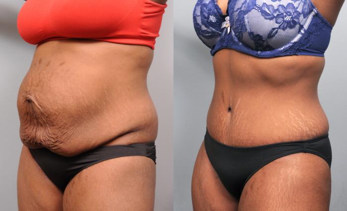 Before & After Tummy Tuck Case 173 View #3 View in New York, NY