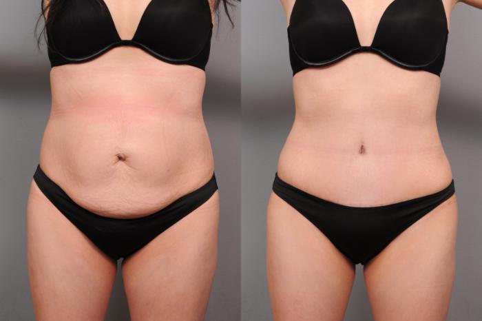 Before & After Tummy Tuck Case 174 View #1 View in New York, NY