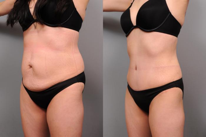 Before & After Tummy Tuck Case 174 View #2 View in New York, NY