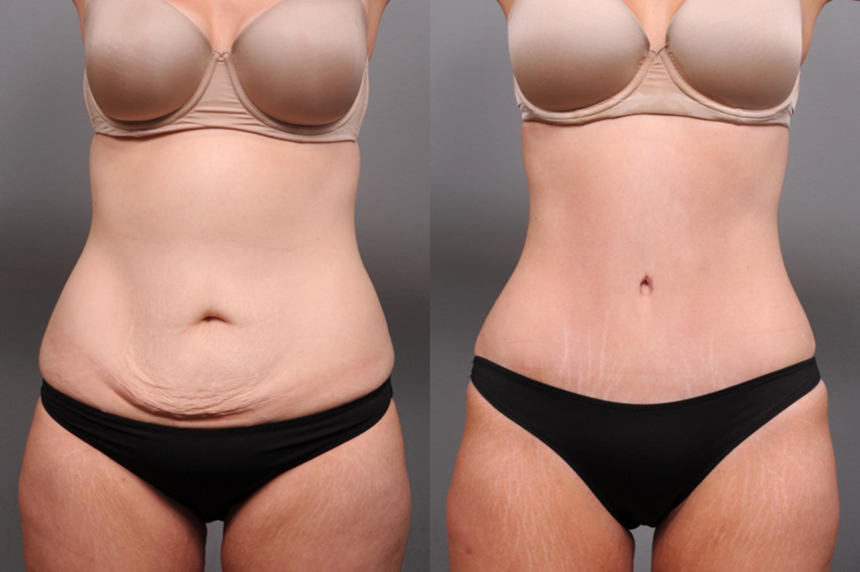 Before & After Tummy Tuck Case 182 View #1 View in New York, NY