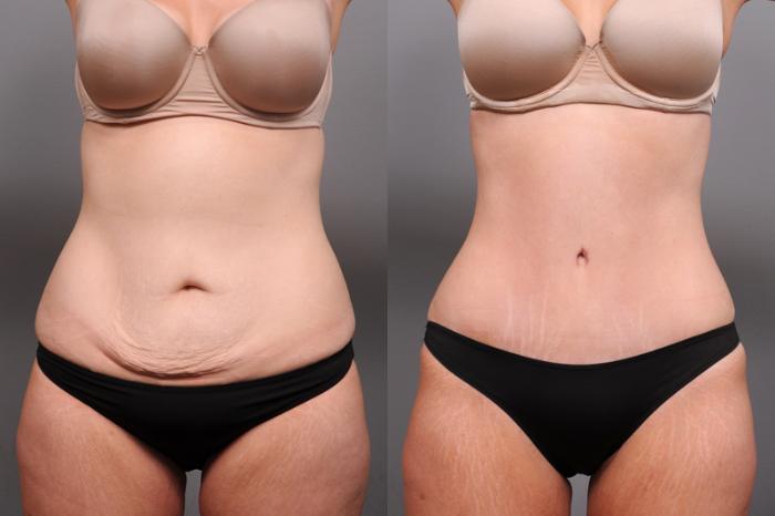 Before & After Tummy Tuck Case 182 View #1 View in New York, NY