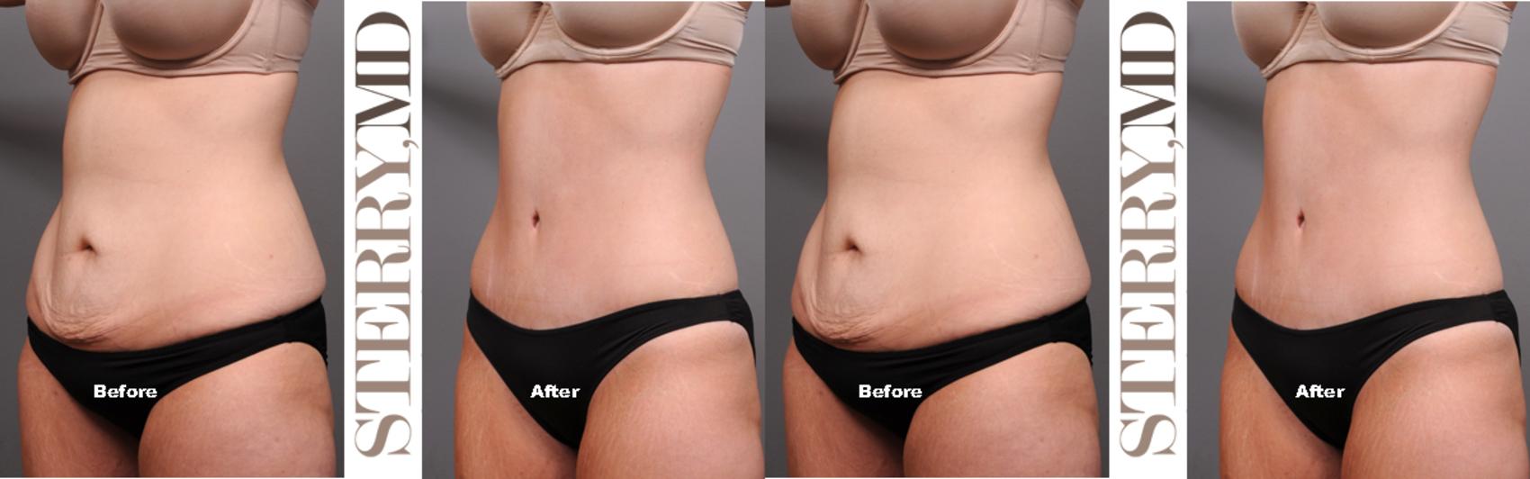 Before & After Tummy Tuck Case 182 View #2 View in New York, NY
