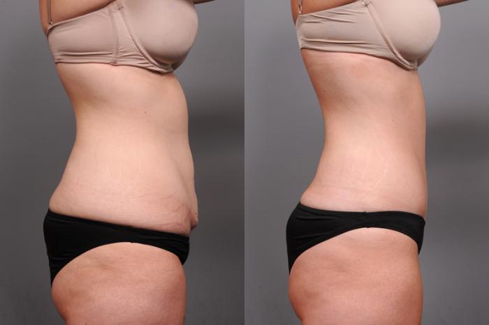 Before & After Tummy Tuck Case 182 View #3 View in New York, NY