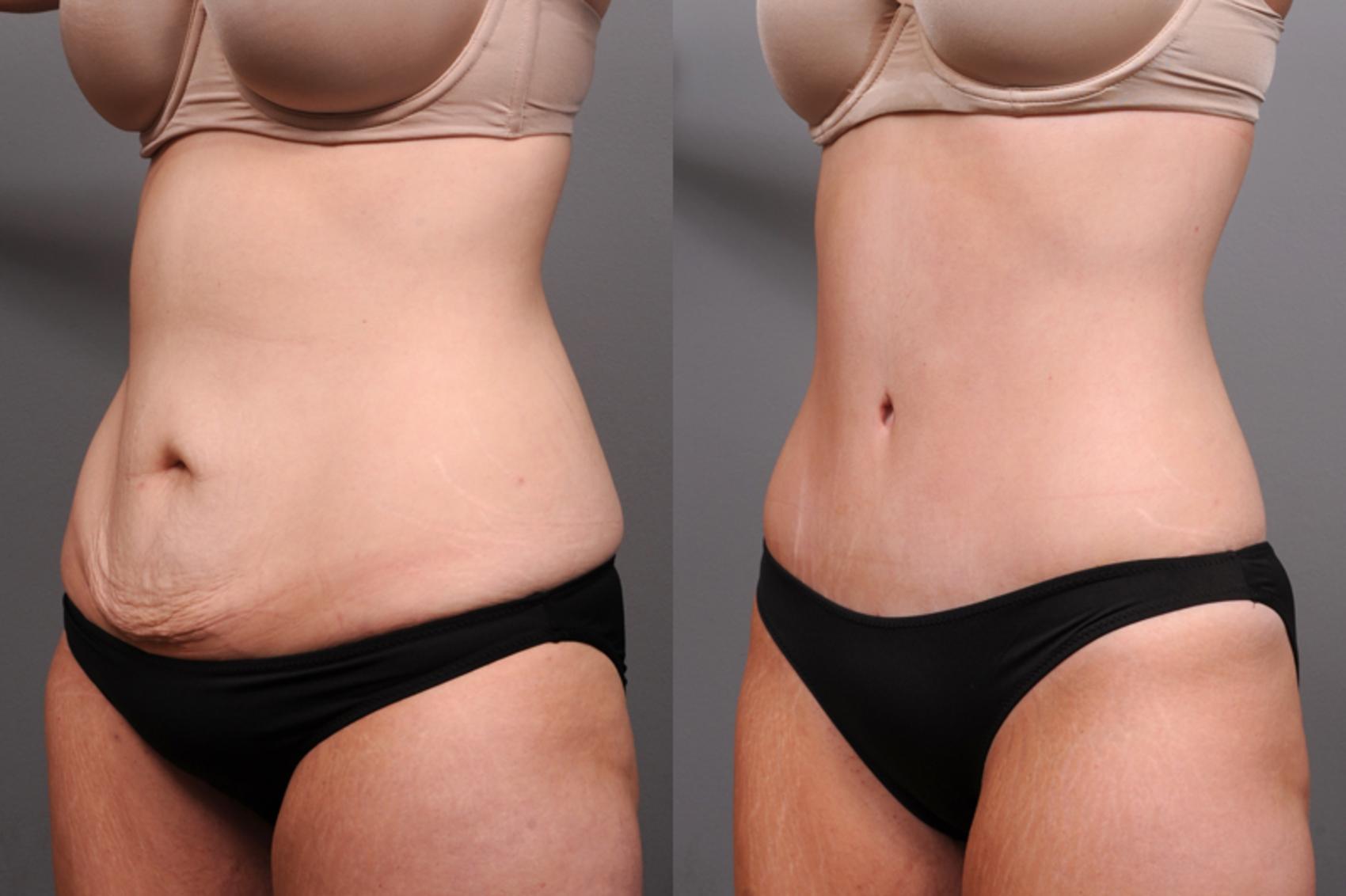 Before & After Tummy Tuck Case 182 View #4 View in New York, NY