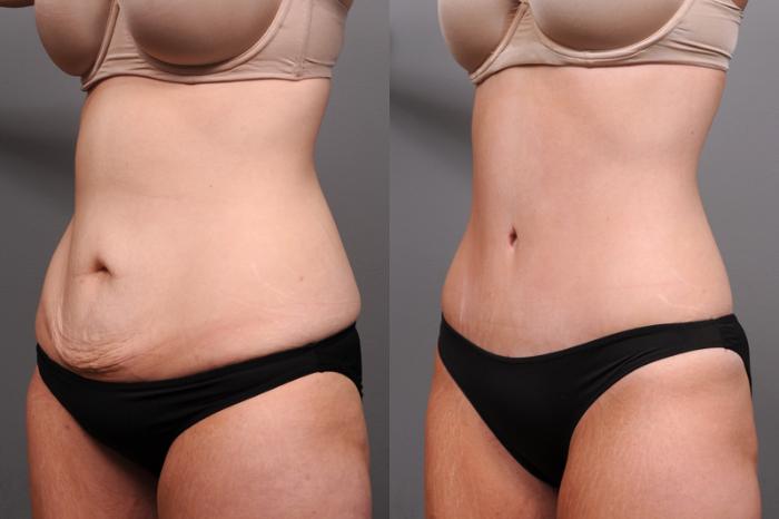 Before & After Tummy Tuck Case 182 View #4 View in New York, NY