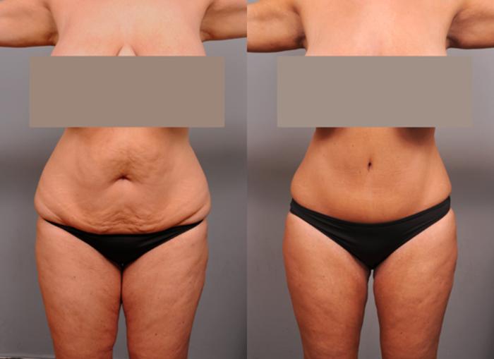 Before & After Tummy Tuck Case 186 View #1 View in New York, NY