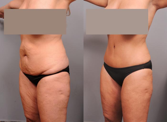 Before & After Tummy Tuck Case 186 View #2 View in New York, NY