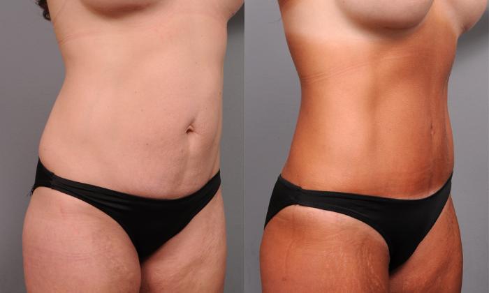 Before & After Tummy Tuck Case 190 View #1 View in New York, NY