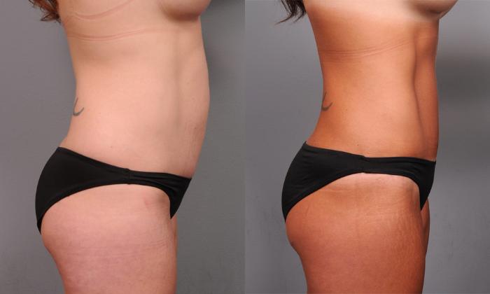 Before & After Tummy Tuck Case 190 View #2 View in New York, NY