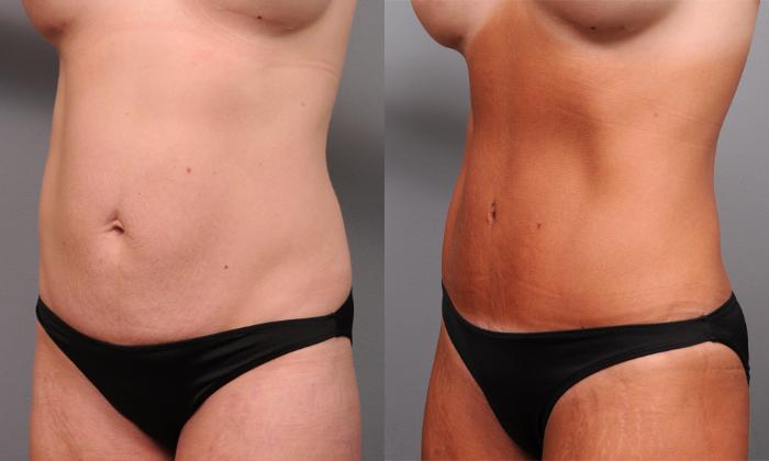 Before & After Tummy Tuck Case 190 View #3 View in New York, NY