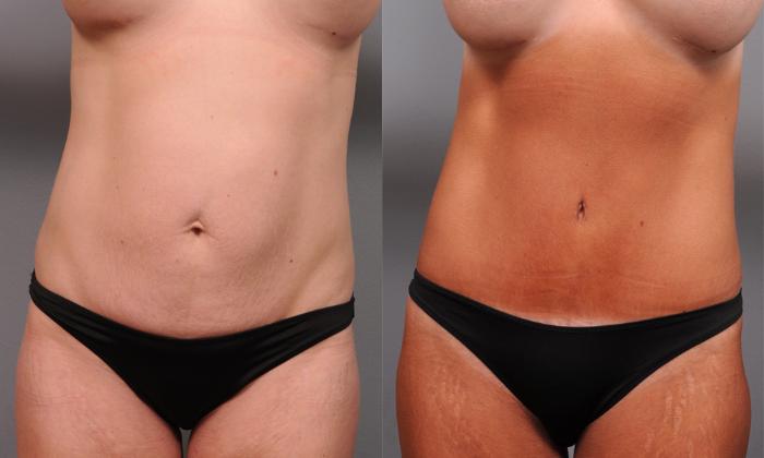 Before & After Tummy Tuck Case 190 View #4 View in New York, NY