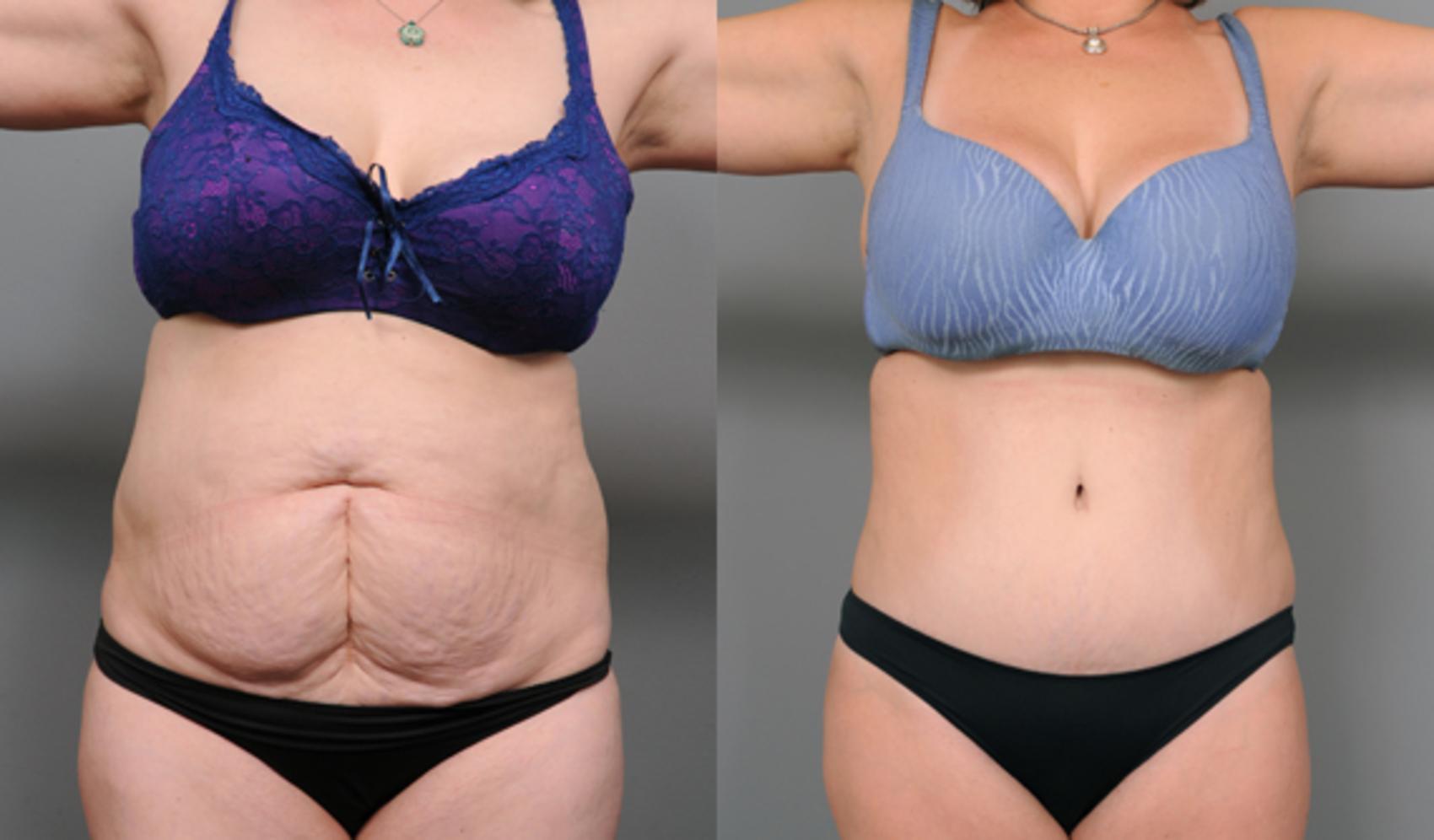 Before & After Tummy Tuck Case 193 View #1 View in New York, NY