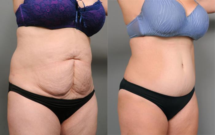Before & After Tummy Tuck Case 193 View #2 View in New York, NY