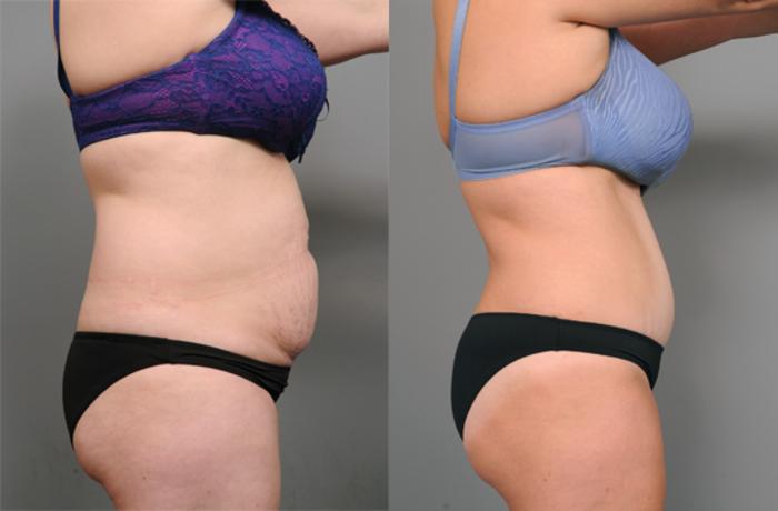 Before & After Tummy Tuck Case 193 View #3 View in New York, NY