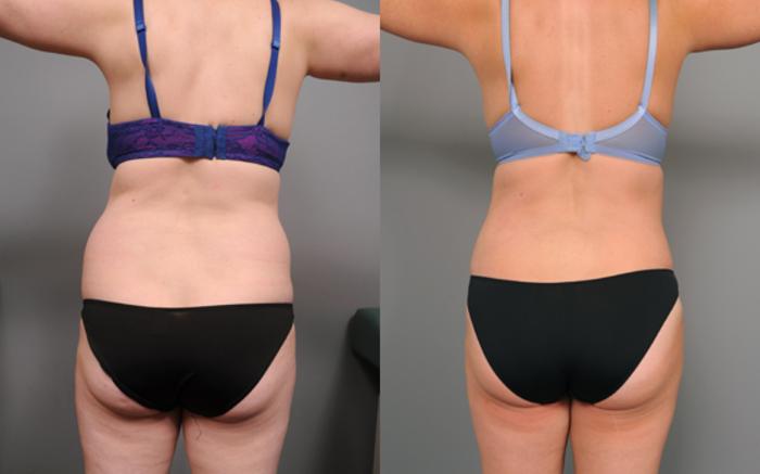Before & After Tummy Tuck Case 193 View #4 View in New York, NY