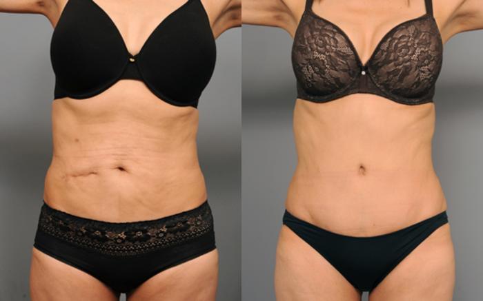 Before & After Tummy Tuck Case 194 View #1 View in New York, NY