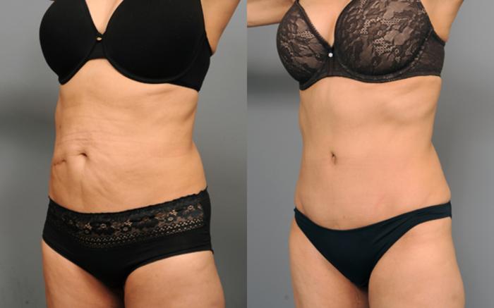 Before & After Tummy Tuck Case 194 View #2 View in New York, NY