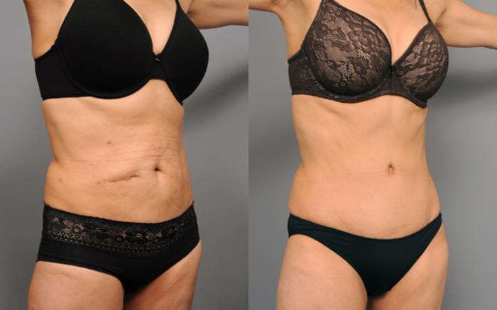 Before & After Tummy Tuck Case 194 View #3 View in New York, NY