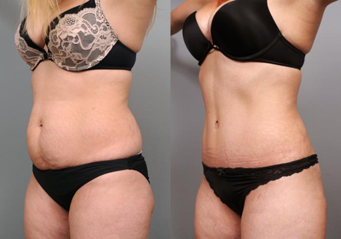 Before & After Tummy Tuck Case 198 View #1 View in New York, NY