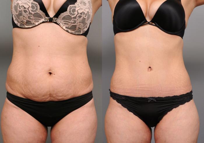 Before & After Tummy Tuck Case 198 View #2 View in New York, NY