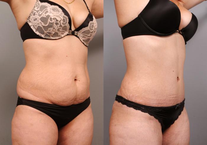 Before & After Tummy Tuck Case 198 View #3 View in New York, NY