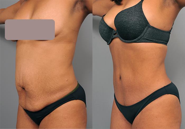 Before & After Tummy Tuck Case 203 View #1 View in New York, NY