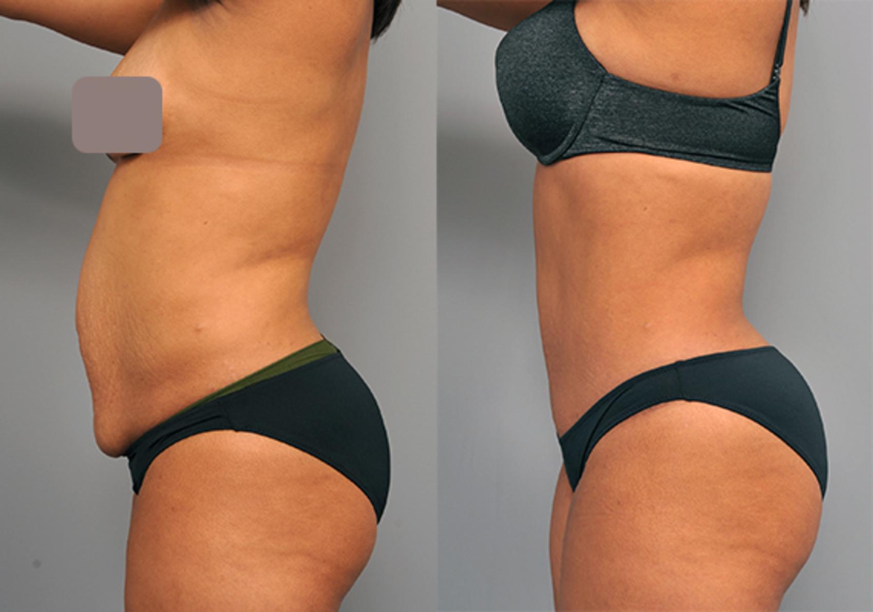 Before & After Tummy Tuck Case 203 View #2 View in New York, NY