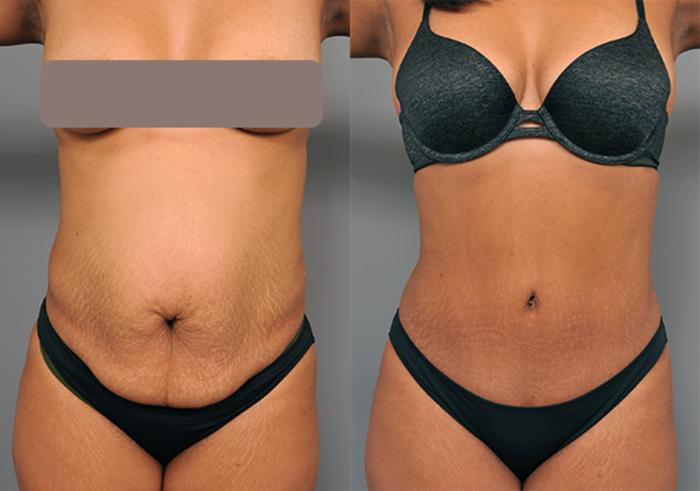 Before & After Tummy Tuck Case 203 View #3 View in New York, NY