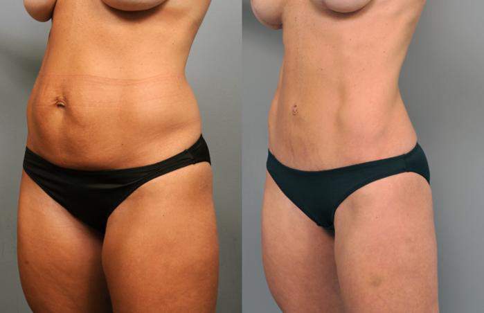 Before & After Tummy Tuck Case 204 View #1 View in New York, NY
