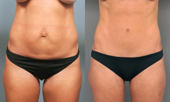 Before & After Tummy Tuck Case 204 View #2 View in New York, NY