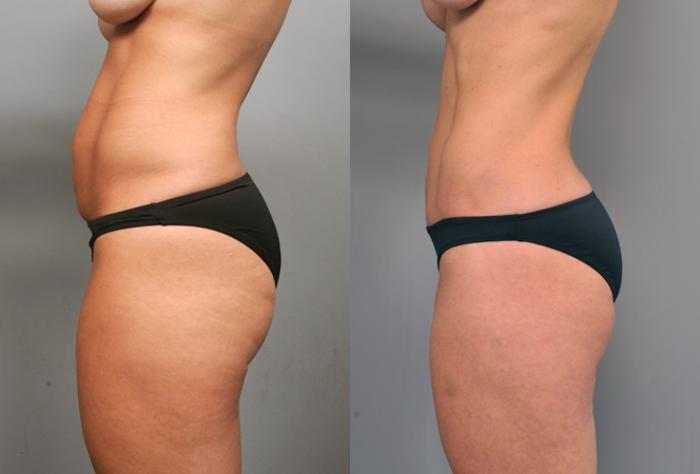Before & After Tummy Tuck Case 204 View #3 View in New York, NY