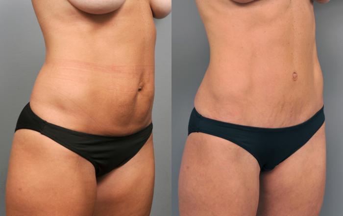 Before & After Tummy Tuck Case 204 View #4 View in New York, NY