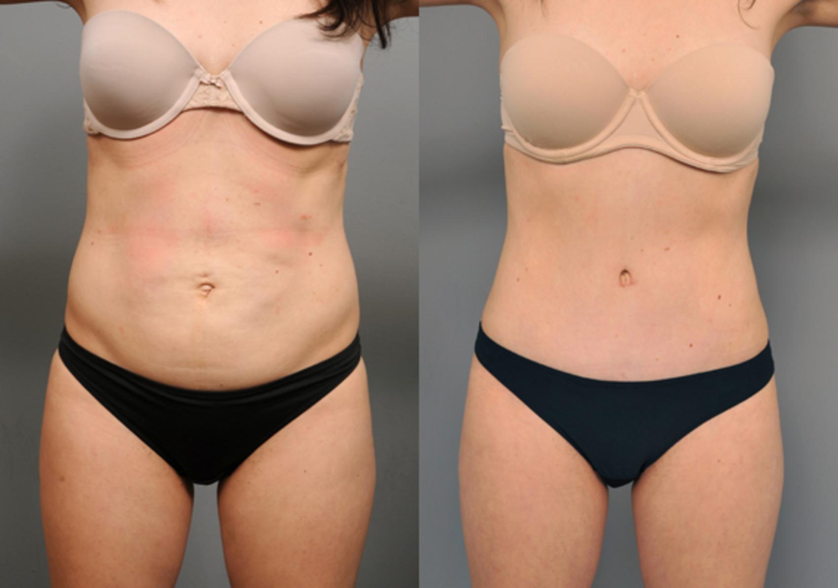 Before & After Tummy Tuck Case 205 View #1 View in New York, NY