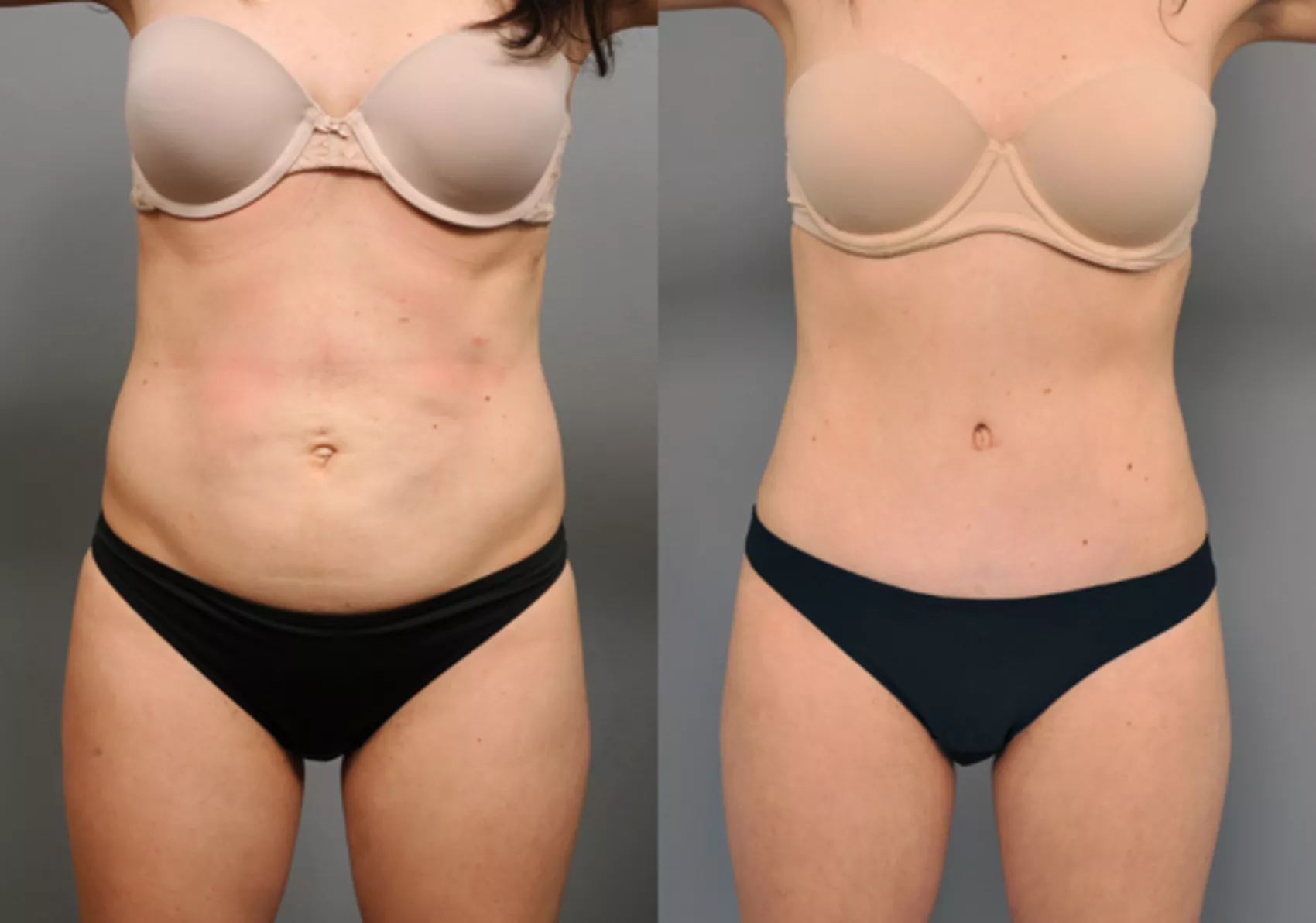 Why Skinny Girls Get Tummy Tucks Too - San Diego Abdominoplasty