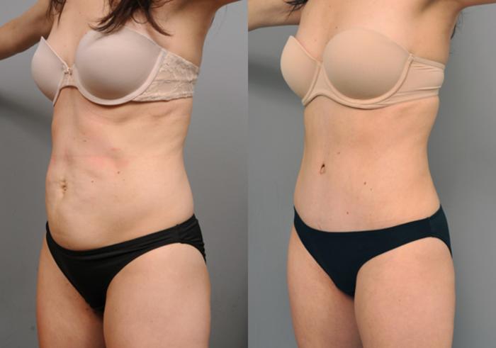 Before & After Tummy Tuck Case 205 View #2 View in New York, NY