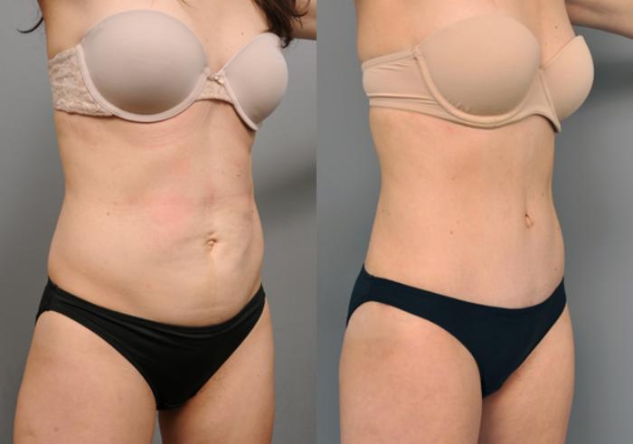 Before & After Tummy Tuck Case 205 View #3 View in New York, NY