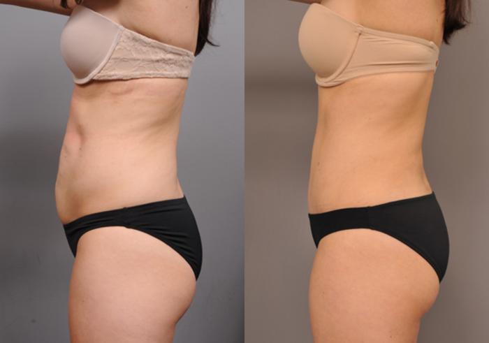Before & After Tummy Tuck Case 205 View #4 View in New York, NY