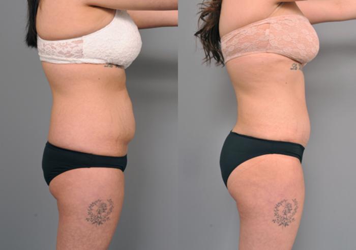 Before & After Tummy Tuck Case 206 View #1 View in New York, NY