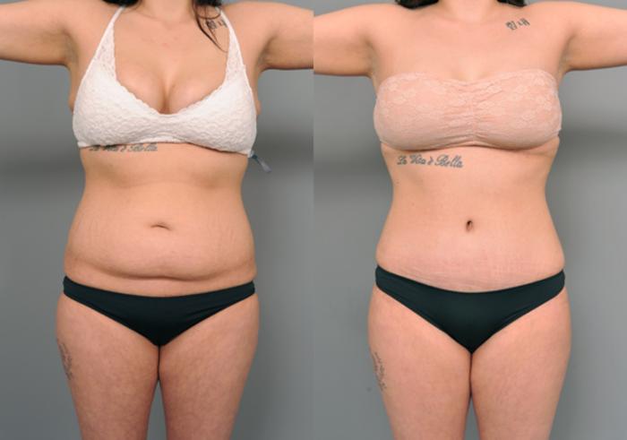 Before & After Tummy Tuck Case 206 View #2 View in New York, NY