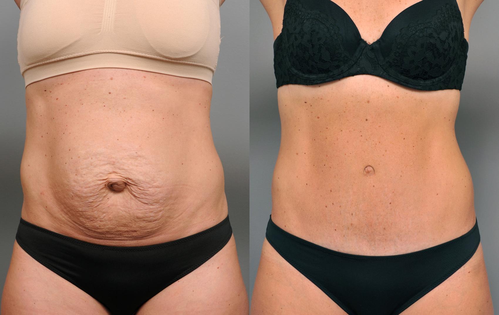 Before & After Tummy Tuck Case 212 View #1 View in New York, NY