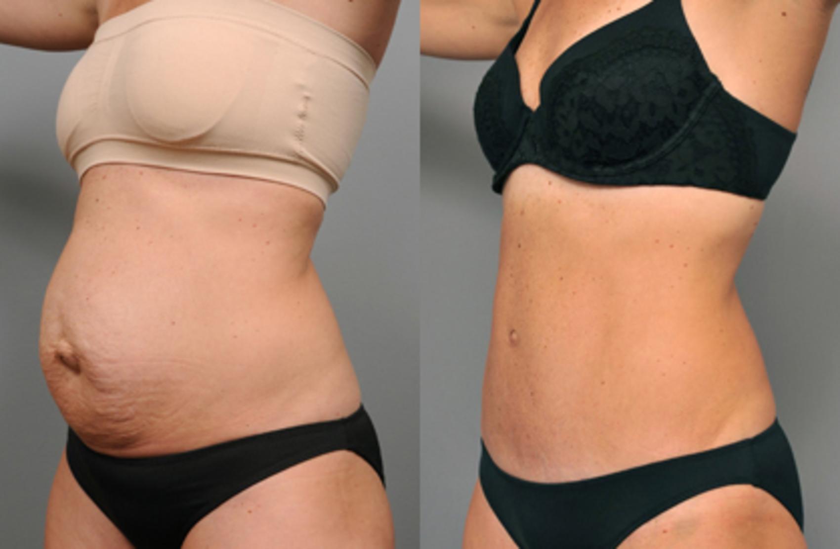 Before & After Tummy Tuck Case 212 View #2 View in New York, NY