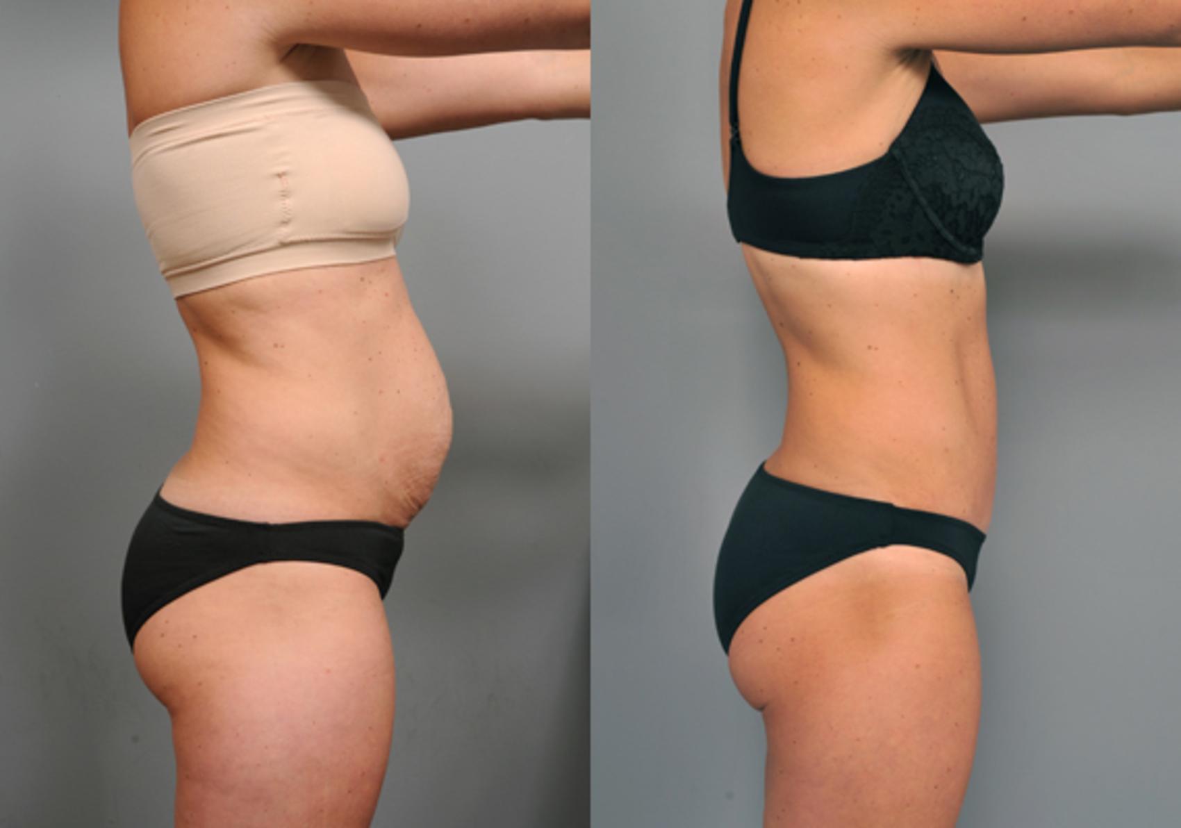 Tummy Tuck after Weight Loss in Brooklyn, NY. Cost, insurance coverage,  benefits, and the importance of choosing a skilled surgeon
