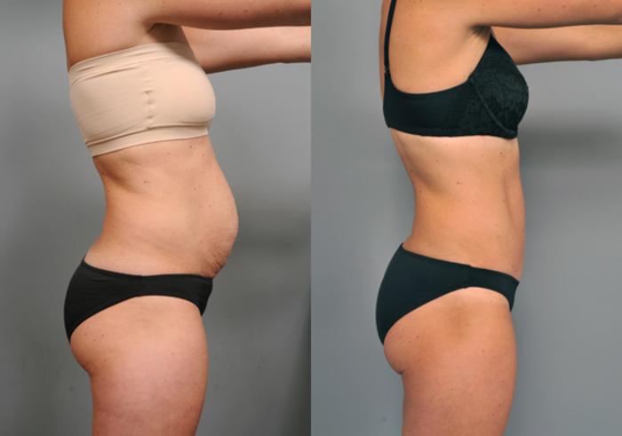 Before & After Tummy Tuck Case 212 View #3 View in New York, NY